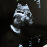 découvrez les meilleurs échographes de poche disponibles dans le tarn, alliant compacité et performance. idéaux pour les professionnels de la santé en quête de précision et de praticité lors de leurs examens médicaux.